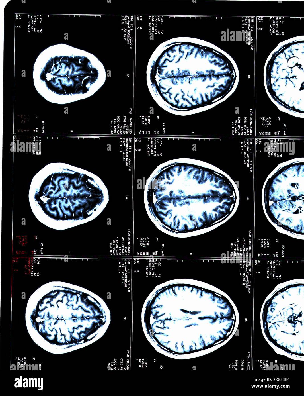 Una risonanza magnetica cerebrale di un paziente con sclerosi multipla Foto Stock