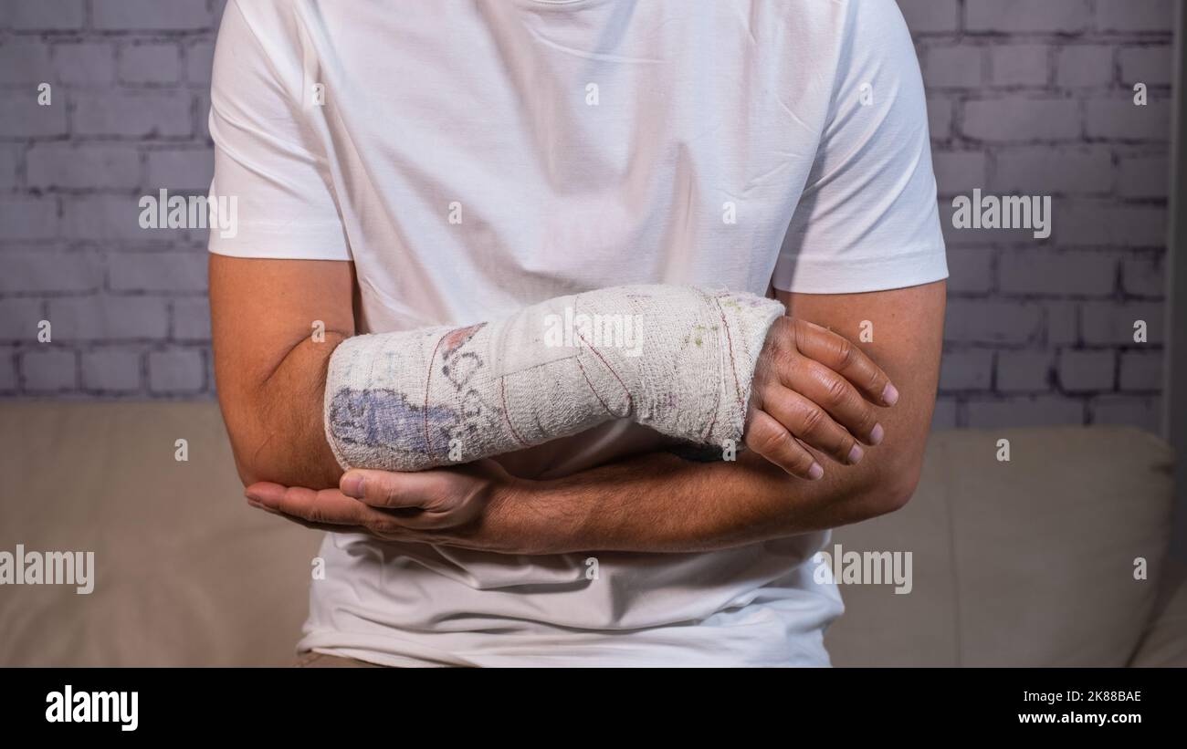 uomo con braccio rotto, frattura del raggio distale Foto Stock