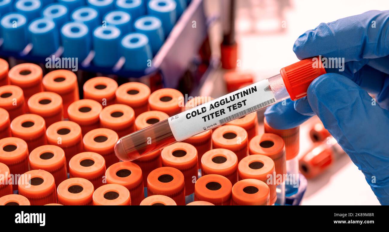 Test del sangue per il titolo dell'agglutinina a freddo, immagine concettuale Foto Stock