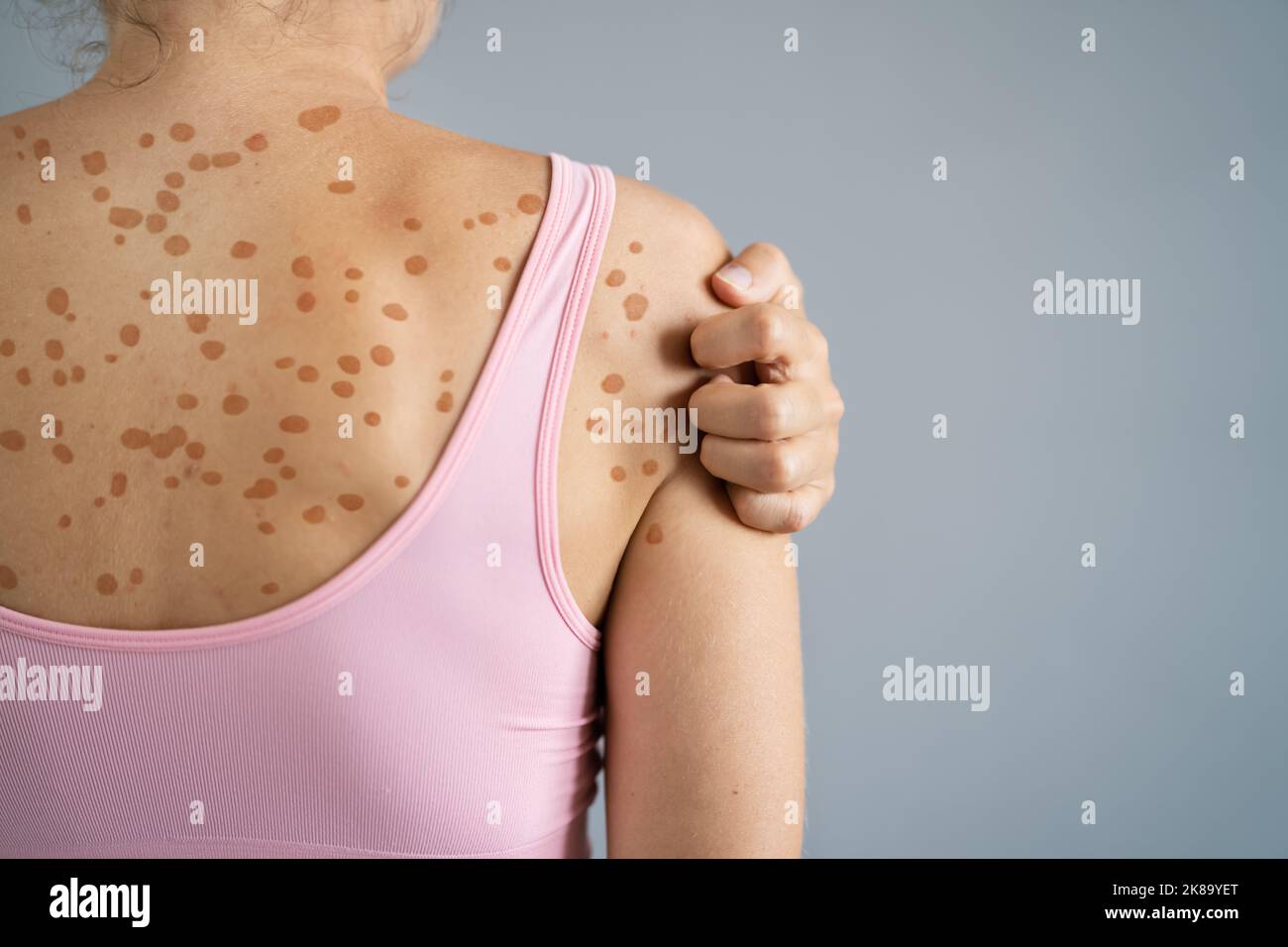 Graffiare la pelle. Eczema sensibile rash e dermatite Foto Stock