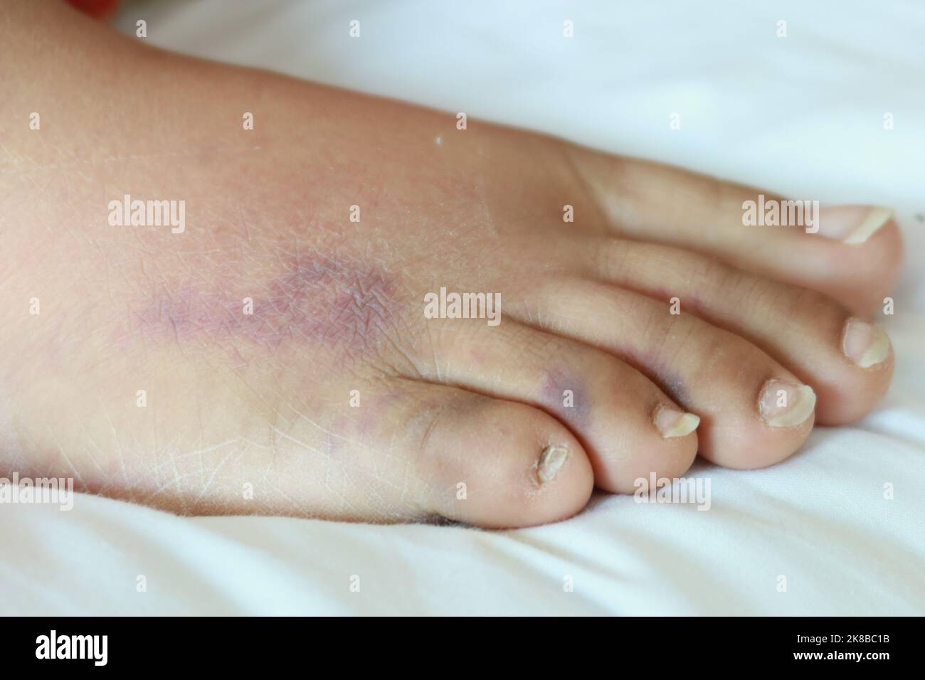 primo piano dei piedi delle donne con gonfiore sul letto Foto Stock