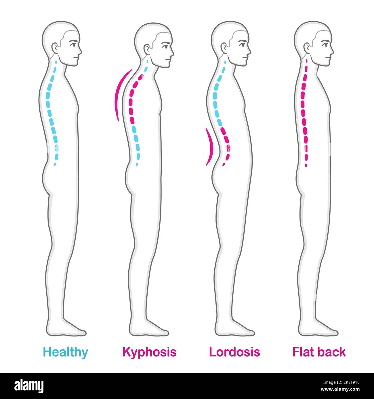 Diagramma medico dei problemi di postura della schiena. Giovane con cifosi, lordosi e schiena piatta, confronto della colonna vertebrale sana. Illustrazione del vettore infografico. Illustrazione Vettoriale