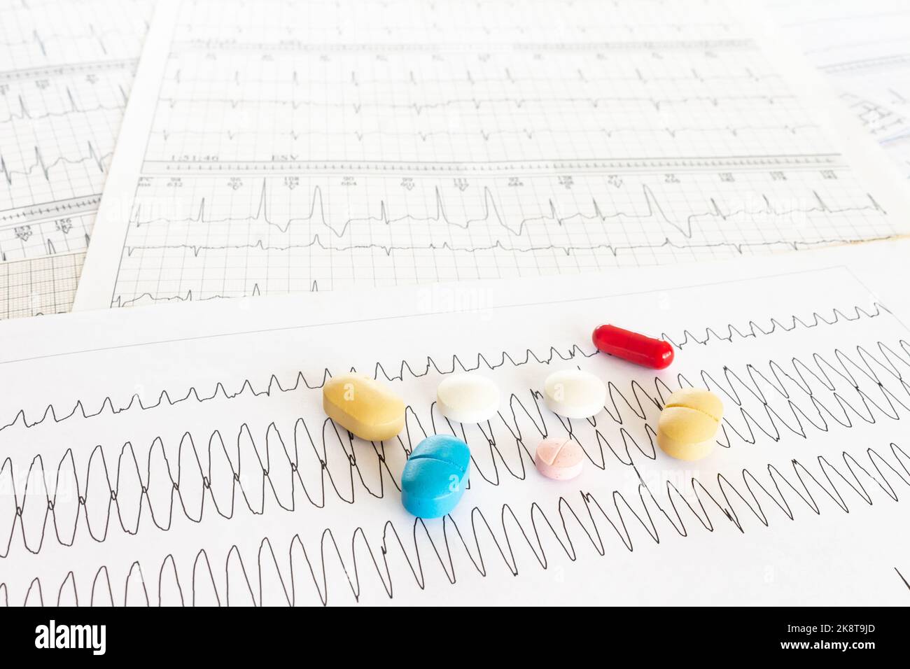 Elettrocardiogramma con tachicardia ventricolare e alcune pillole colorate. Concetto di malattia cardiovascolare. Foto Stock