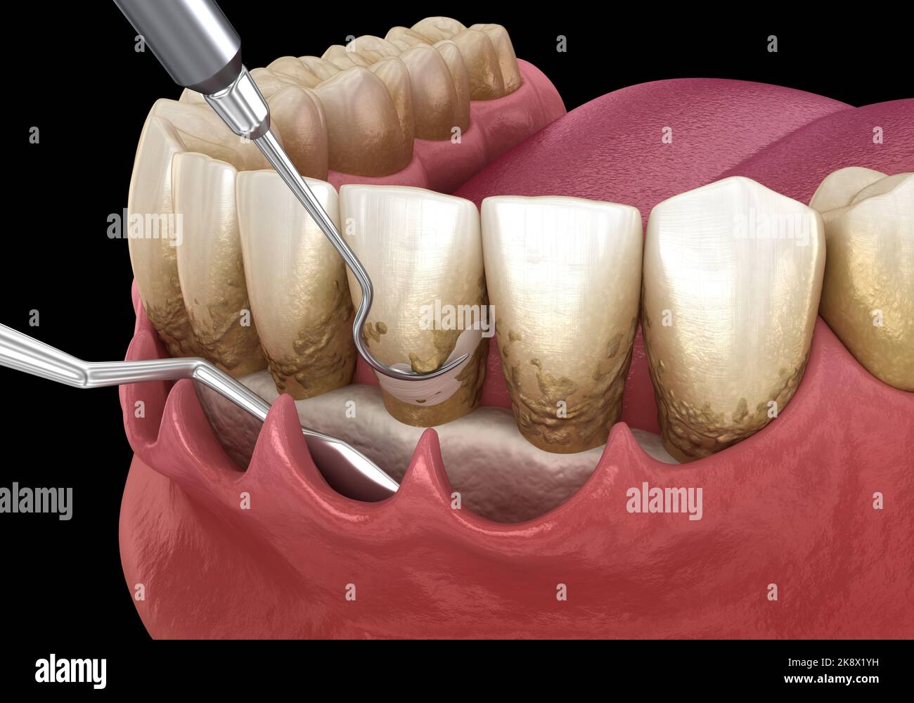 Curettage aperto: Scalatura e radicolare (terapia parodontale convenzionale). Illustrazione 3D accurata dal punto di vista medico del trattamento dei denti umani Foto Stock