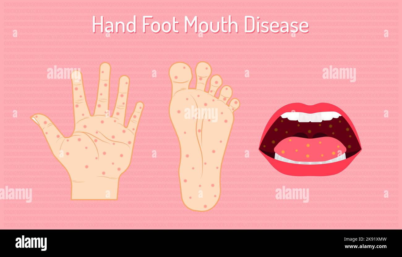Un vettore di malattia delle mani, dell'afta epizootica su sfondo rosa Illustrazione Vettoriale