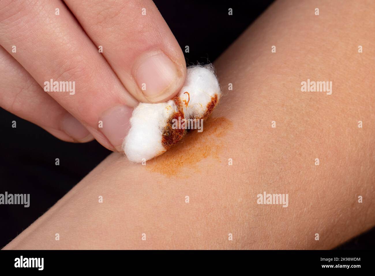 cauterizzazione di una ferita sul braccio con una soluzione di iodio e lana di cotone, salute della pelle. Foto Stock