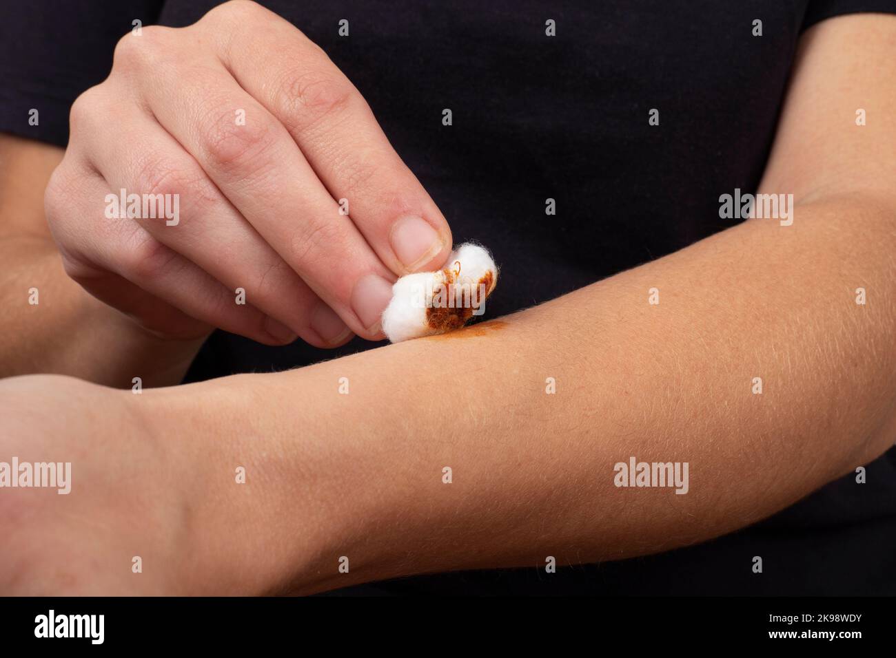 cauterizzazione di una ferita sul braccio con una soluzione di iodio e lana di cotone, salute della pelle. Foto Stock
