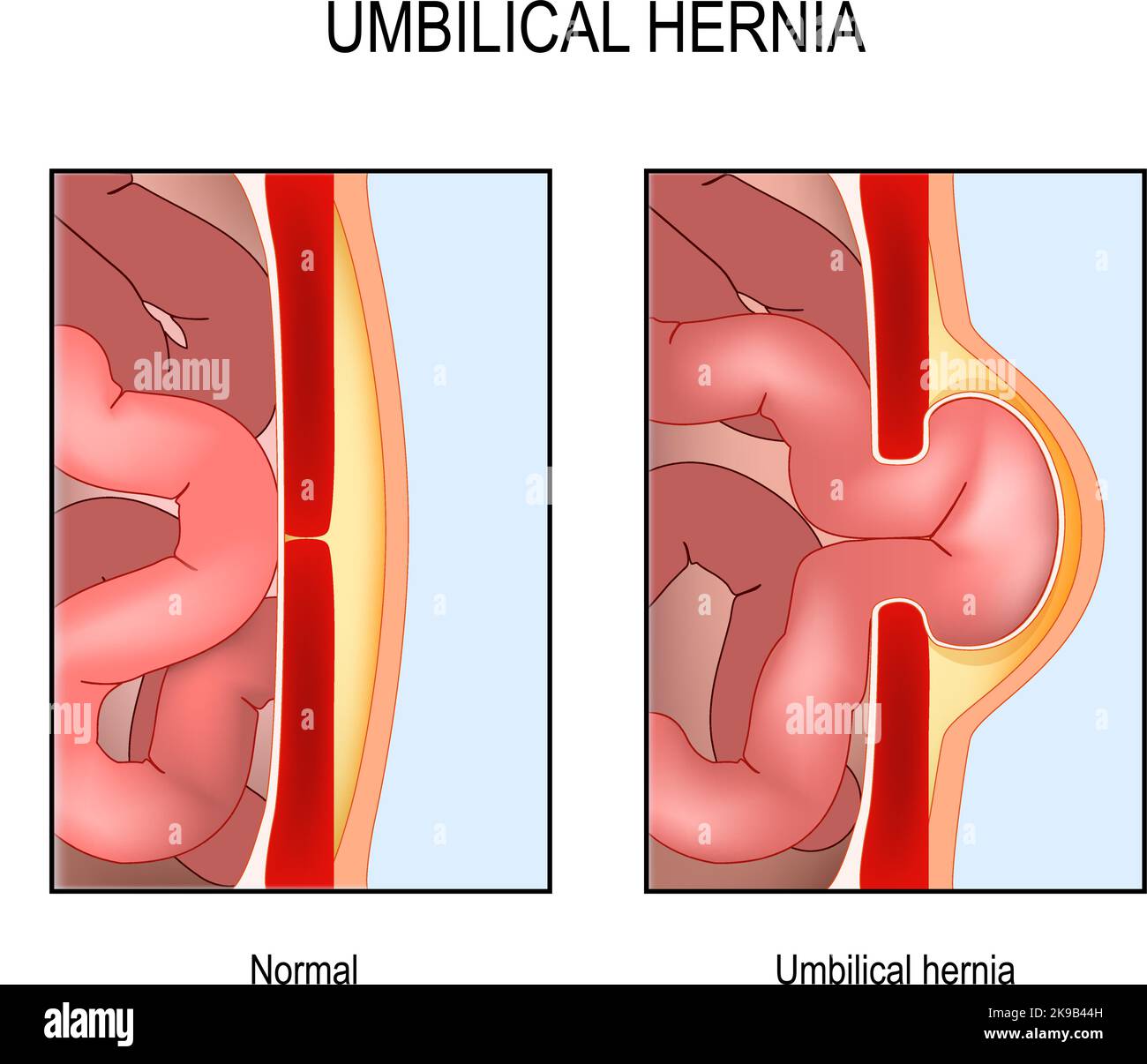 Ernia ombelicale. Sezione trasversale dell'addome con intestino tenue, muscolo e parete addominale. Normale pancia umana e rottura muscolare con sacco erniale. Illustrazione Vettoriale