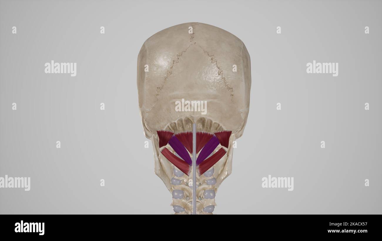 Muscoli suboccipitali colorati Rectus Capitis posteriore maggiore Foto Stock