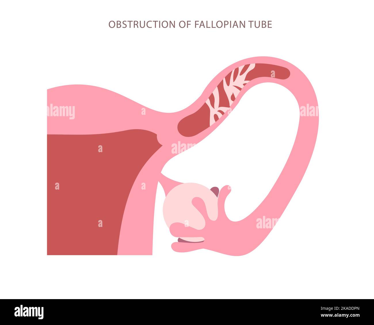Grafico piatto del tubo di Falloppio ostruito. Blocco dello schema di ingrandimento elevato del tubo uterino Illustrazione Vettoriale
