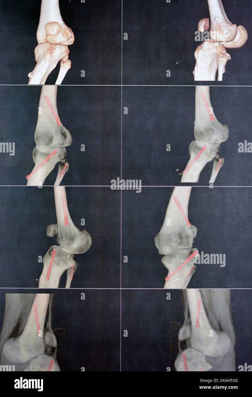 Angiografia TC del ginocchio sinistro 3D che mostra l'arteria poplitea brevettata e le sue biforcazioni arterie tibiali e peroneali su un paziente con bilaterale Foto Stock
