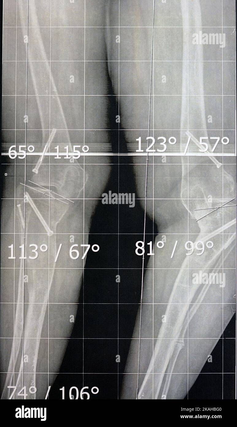 Posizione eretta con pellicola lunga radiogena piana che mostra entrambe le gambe con varum genu metafisario bilaterale, epifisiodesi precedenti, valgo femorale distale sinistro e. Foto Stock
