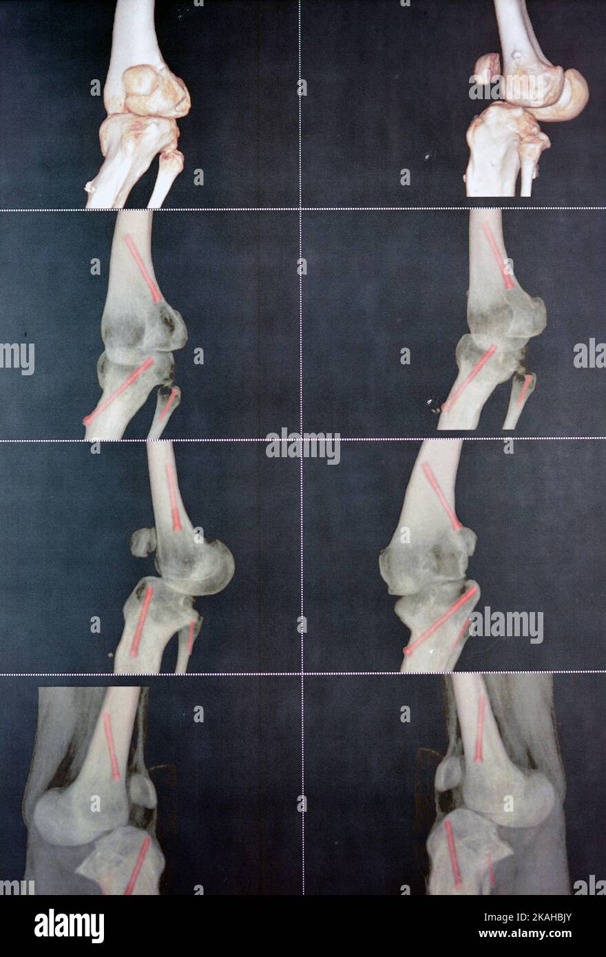 Angiografia TC del ginocchio sinistro 3D che mostra l'arteria poplitea brevettata e le sue biforcazioni arterie tibiali e peroneali su un paziente con bilaterale Foto Stock