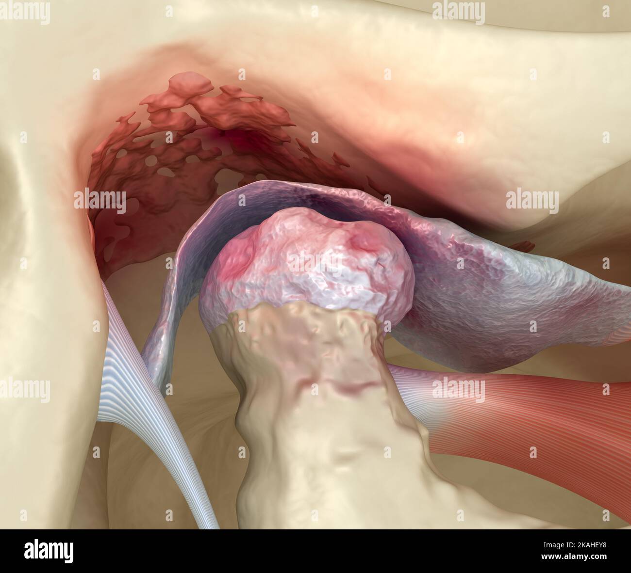 Artrite delle articolazioni temporomandibolari e disco articolare dislocato. Illustrazione 3D accurata dal punto di vista medico. Foto Stock