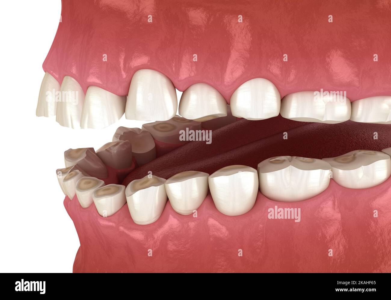 Attrito dentale (bruxismo) con conseguente perdita del tessuto dentale. Illustrazione del dente 3D accurata dal punto di vista medico Foto Stock