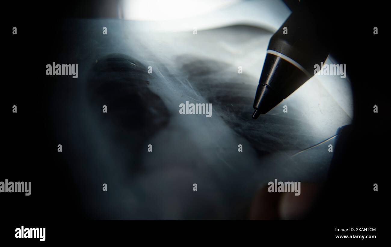 Radiografia polmonare estrema primo piano, medico o professore che effettua esami a raggi X con penna, concetto di medicina Foto Stock