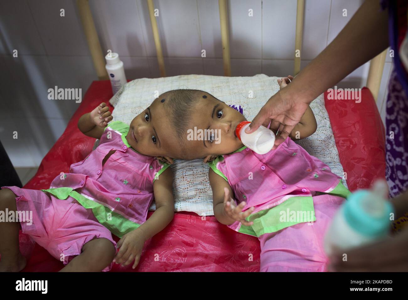 Le ragazze gemelle Rabeya Islam e Rokeya Islam bevono latte in un ospedale a Dhaka, Bangladesh, il 29 luglio 2017. Taslima Khatun, insegnante di scuola, ha dato alla luce i gemelli a testa riunita il 16 luglio 2016 dopo un cesareo. I gemelli sono stati ricoverati in un ospedale governativo per un esame prima di un eventuale intervento chirurgico per separare la testa. (Foto di Zakir Hossain Chowdhury/NurPhoto) *** Please use Credit from Credit Field *** Foto Stock