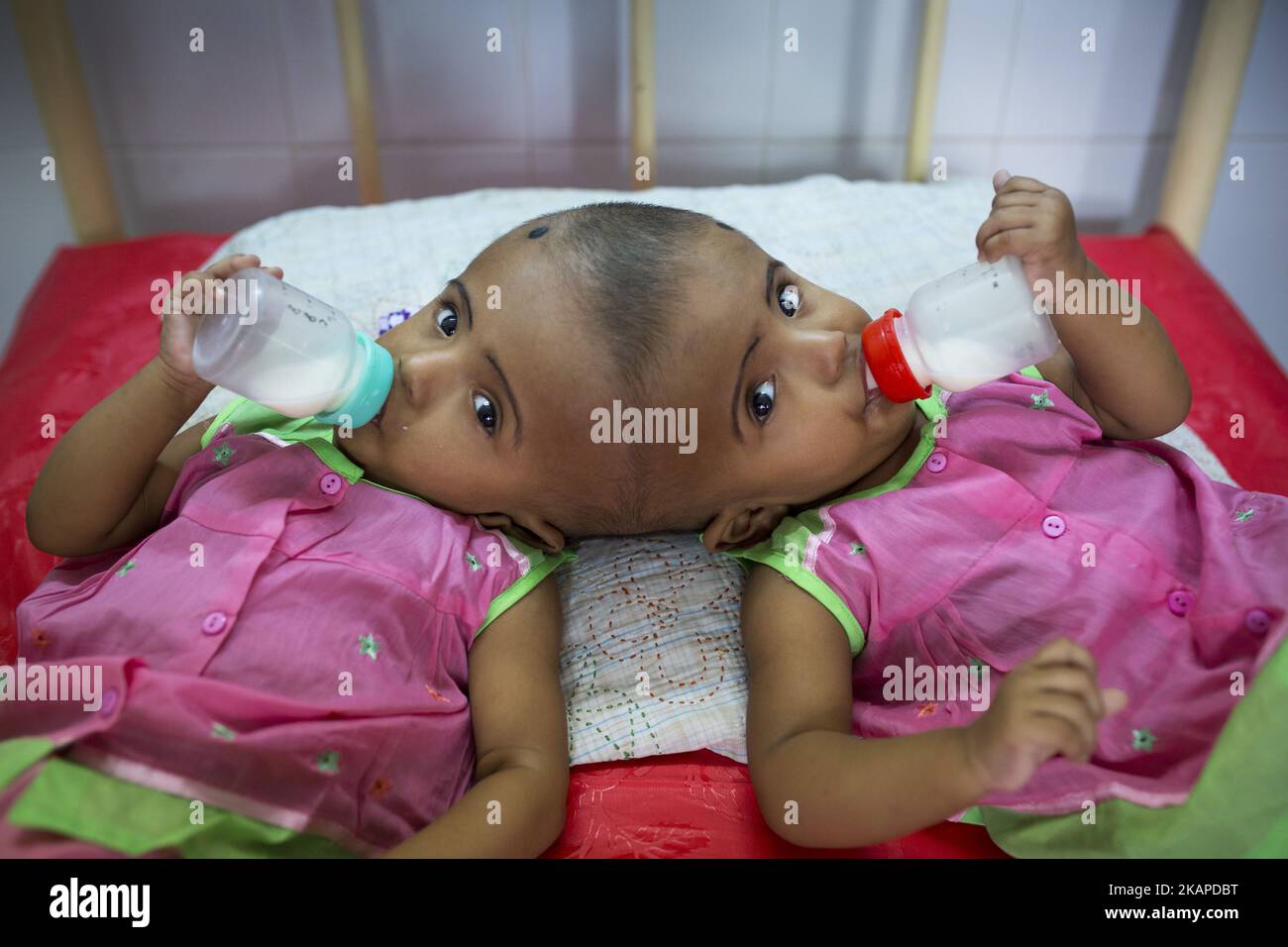 Le ragazze gemelle Rabeya Islam e Rokeya Islam bevono latte in un ospedale a Dhaka, Bangladesh, il 29 luglio 2017. Taslima Khatun, insegnante di scuola, ha dato alla luce i gemelli a testa riunita il 16 luglio 2016 dopo un cesareo. I gemelli sono stati ricoverati in un ospedale governativo per un esame prima di un eventuale intervento chirurgico per separare la testa. (Foto di Zakir Hossain Chowdhury/NurPhoto) *** Please use Credit from Credit Field *** Foto Stock