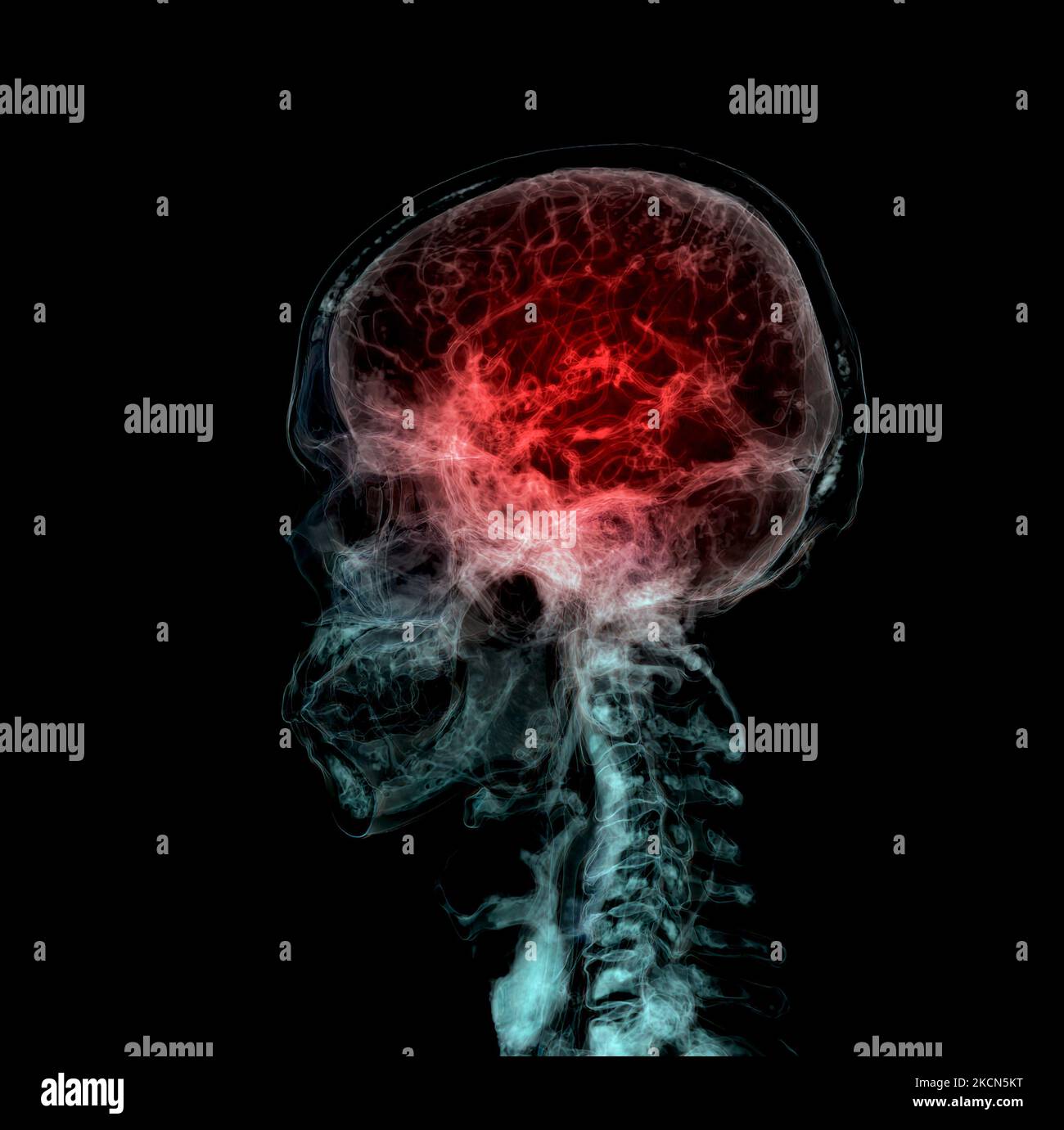 3D ha reso clinicamente accurata l'illustrazione dell'arteria cerebrale della testa Foto Stock