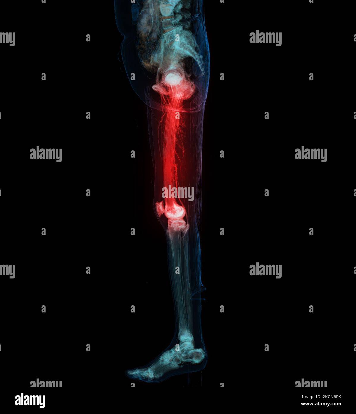 CT scan of Lower extremity ,3D Illustration of Femur bone , knee joint , leg and foot . Foto Stock