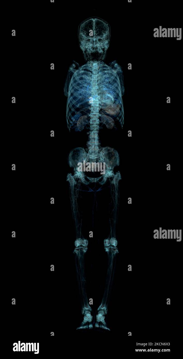 Scansione TC di tutto il corpo umano. Foto Stock