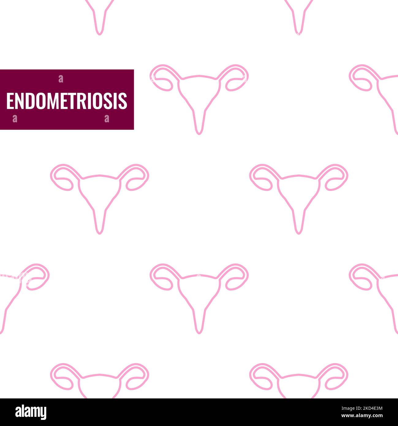 Endometriosi, illustrazione concettuale Foto Stock