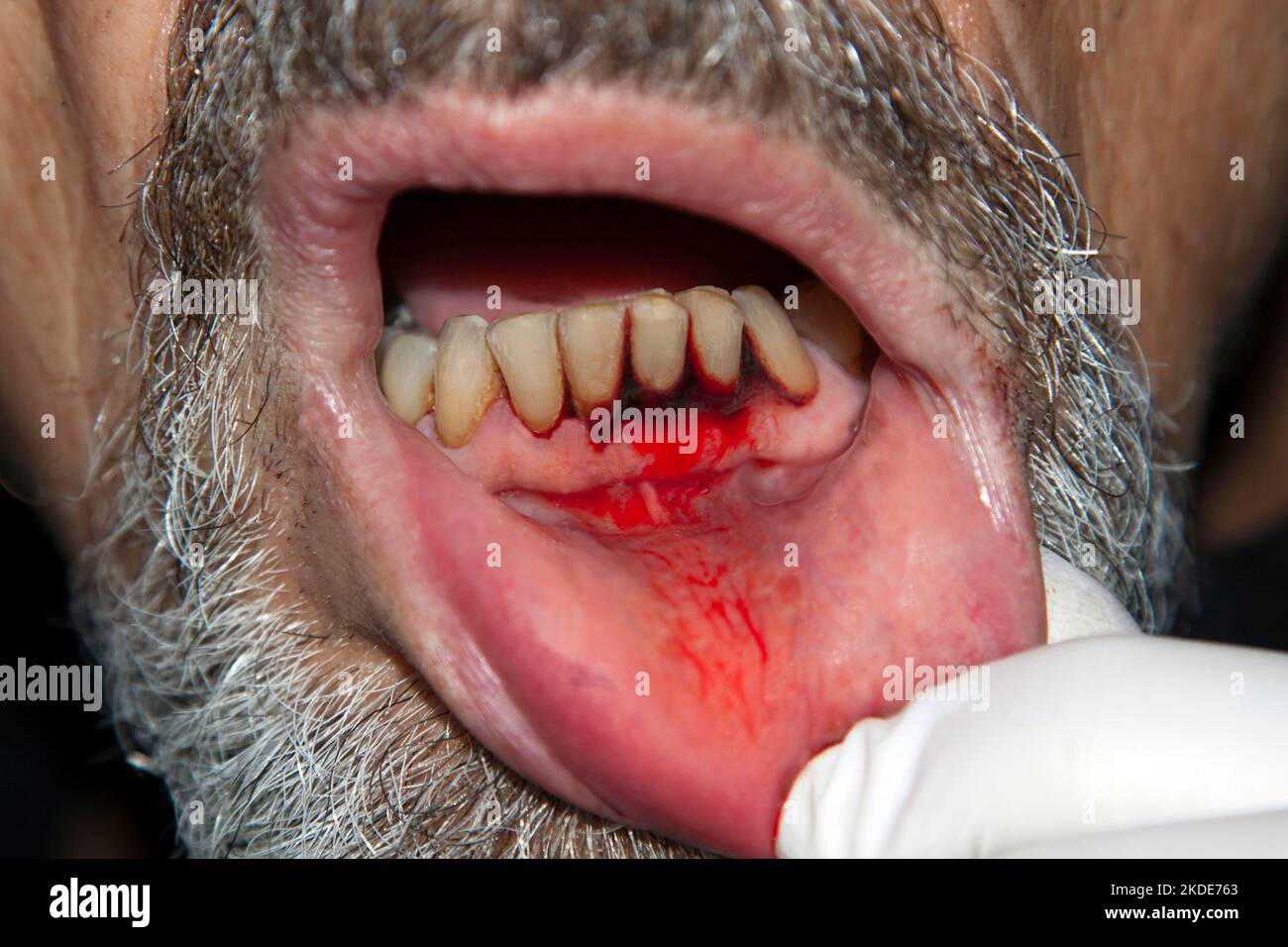 Immagine simbolica per parodontite, gengive molto sanguinanti Foto Stock