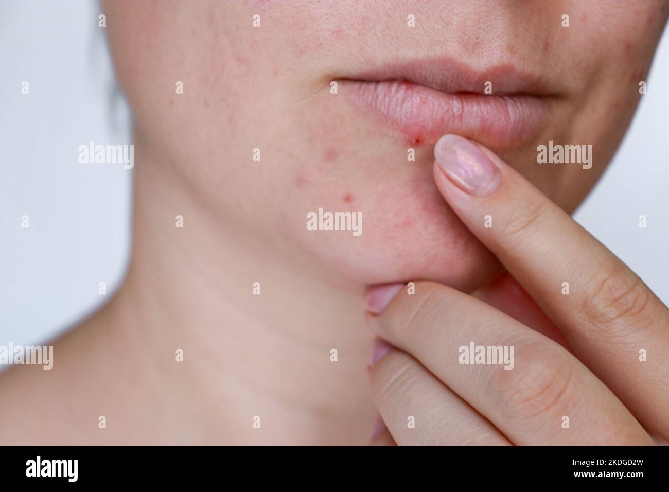 primo piano donna naturale cattiva pelle acne con cicatrici Foto Stock