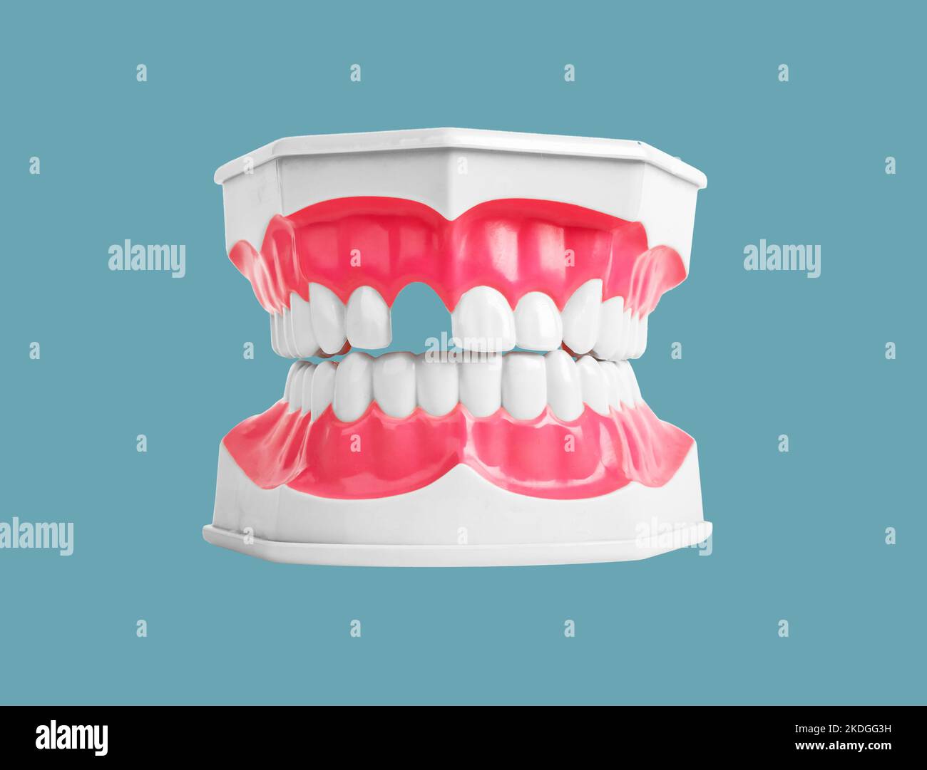 Concetto di perdita dei denti. Denti mancanti nel modello di ganascia sullo sfondo. Problemi di odontoiatria. Distanza, assenza. Foto di alta qualità Foto Stock