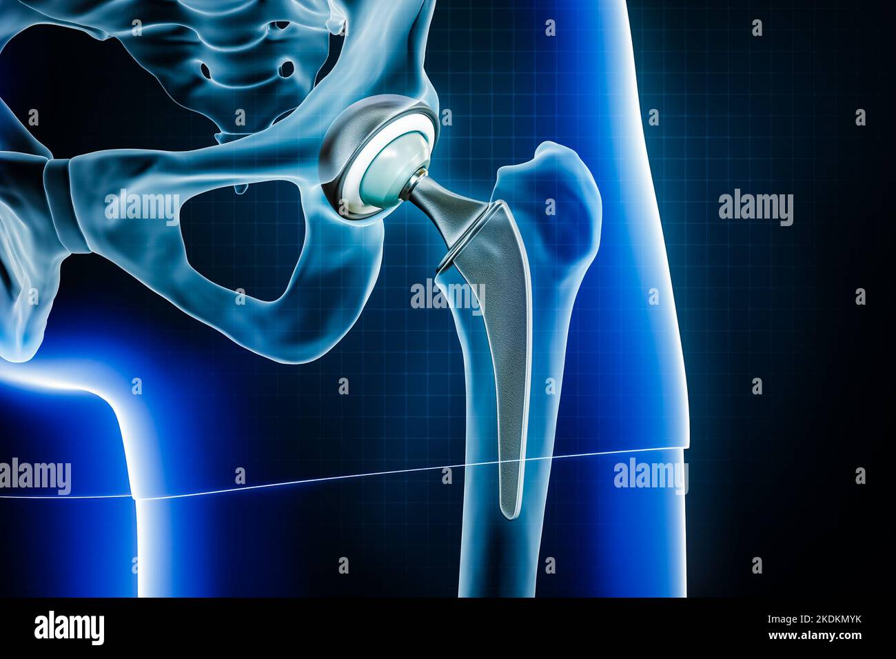 Protesi femorale dell'anca o impianto. Illustrazione della sostituzione totale dell'articolazione dell'anca o dell'artroplastica 3D. Medico e sanitario, arthrit Foto Stock