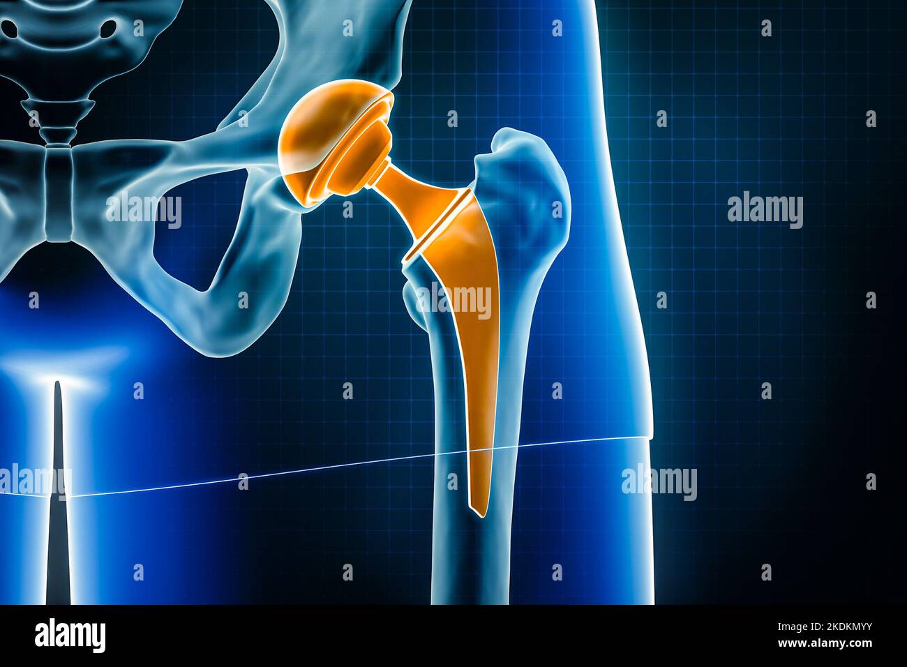 Illustrazione del rendering a raggi X 3D della protesi dell'anca. Intervento chirurgico di sostituzione totale dell'articolazione dell'anca o artroplastica, medico e sanitario, artrite, patologia, sci Foto Stock