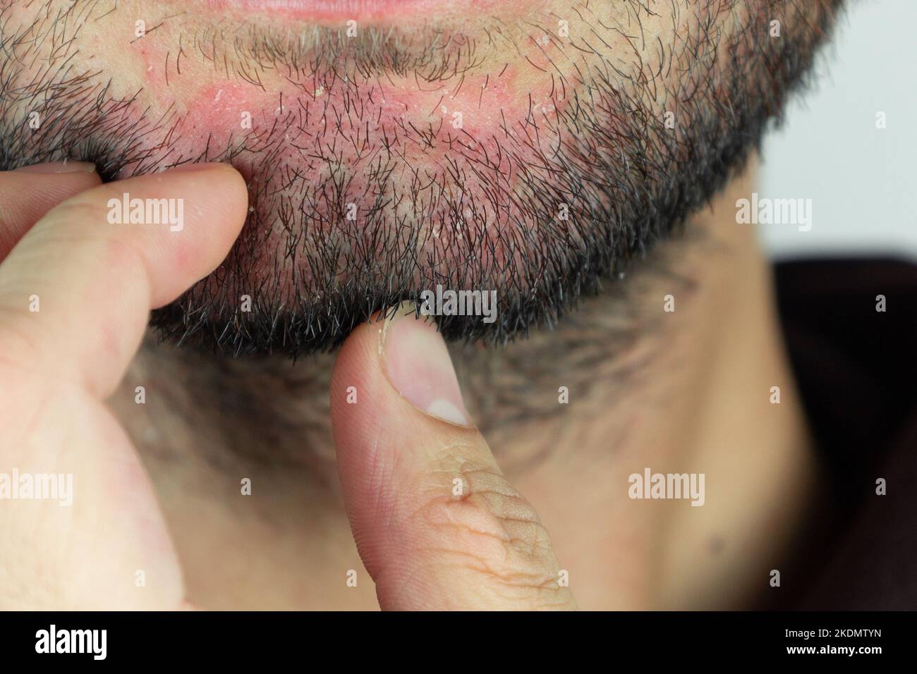 Dermatite seborroica nella barba. Eczema sul viso maschile primo piano. Foto Stock