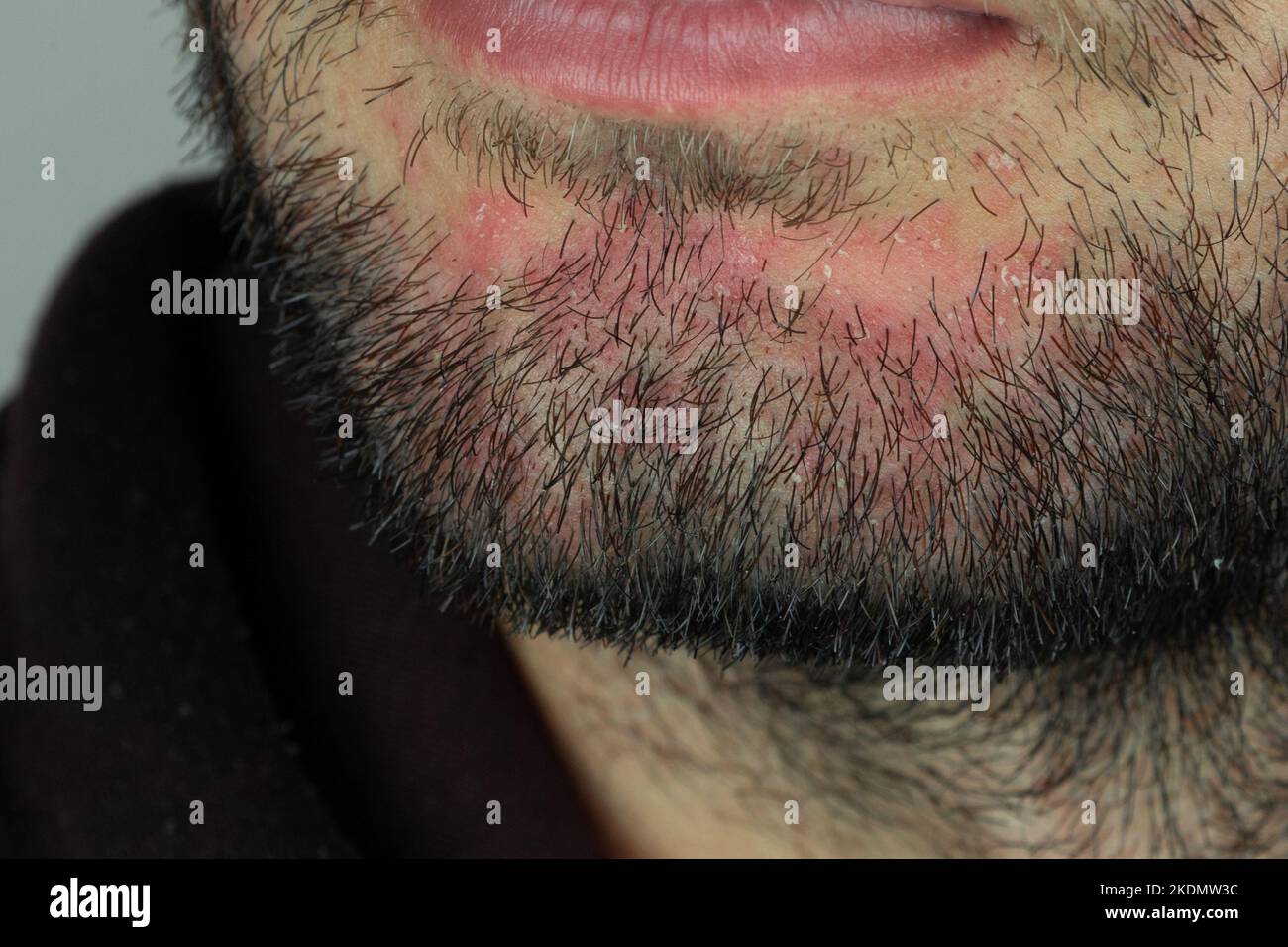 Dermatite seborroica nella barba. Eczema sul viso maschile primo piano. Foto Stock
