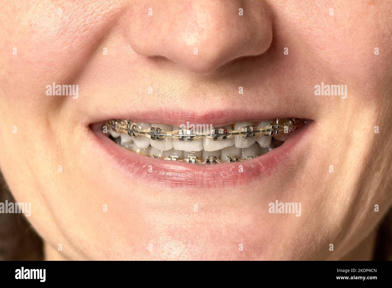 un sorriso di donna con denti aperti su cui ci sono sostegni Foto Stock