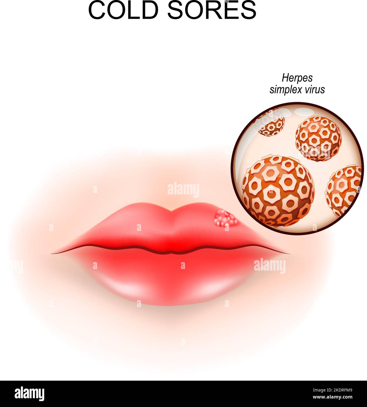 Herpes labiale nelle labbra. Vesciche di febbre. Primo piano di un virus Herpes Simplex. Illustrazione vettoriale Illustrazione Vettoriale
