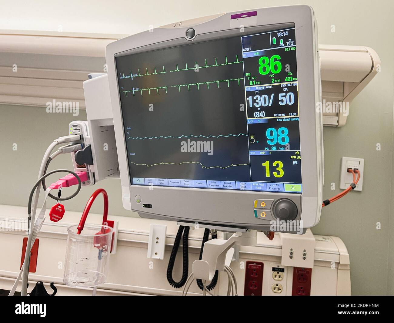Sistema di monitoraggio dei segni vitali in ospedale Foto Stock