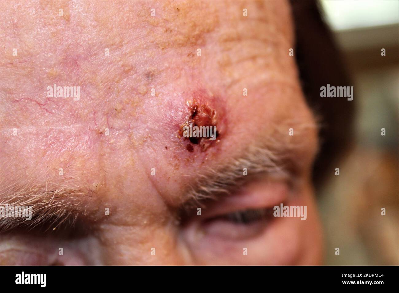 Carcinoma a cellule squamose sulla fronte di una donna anziana Foto Stock