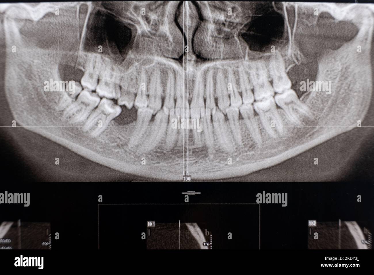 Scansione TC di un paziente con denti da masticare mancanti e malocclusione Foto Stock