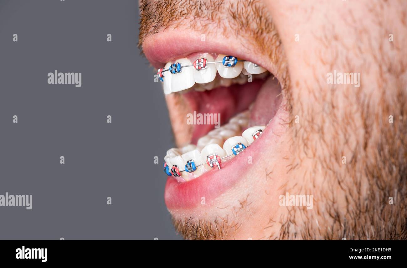 Vicino ai denti si rinforzano sui denti bianchi dell'uomo per equalizzare i denti. Sistema a staffa in bocca sorridente, macro denti fotografici, labbra ravvicinate, macro Foto Stock