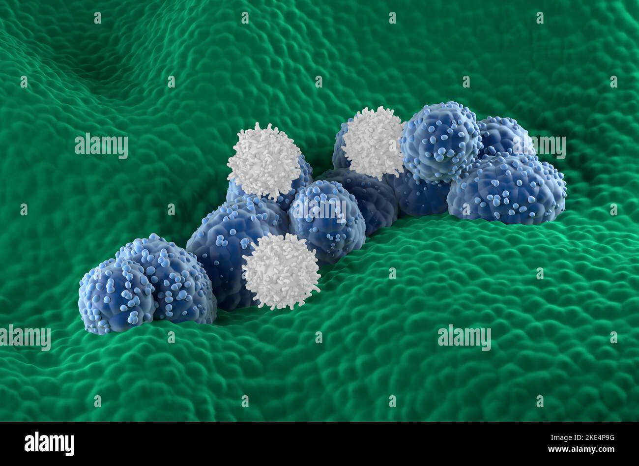 Le cellule T attaccano le cellule del cancro della prostata nell'epitelio ghiandolare prostatico - vista isometrica 3D illustrazione Foto Stock