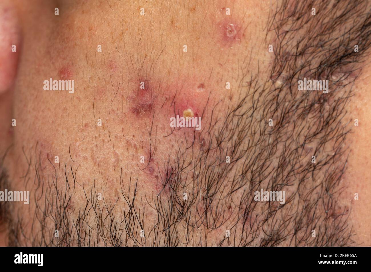 vista ravvicinata di una pelle guancia dell'uomo con acne - problema medico della pelle Foto Stock