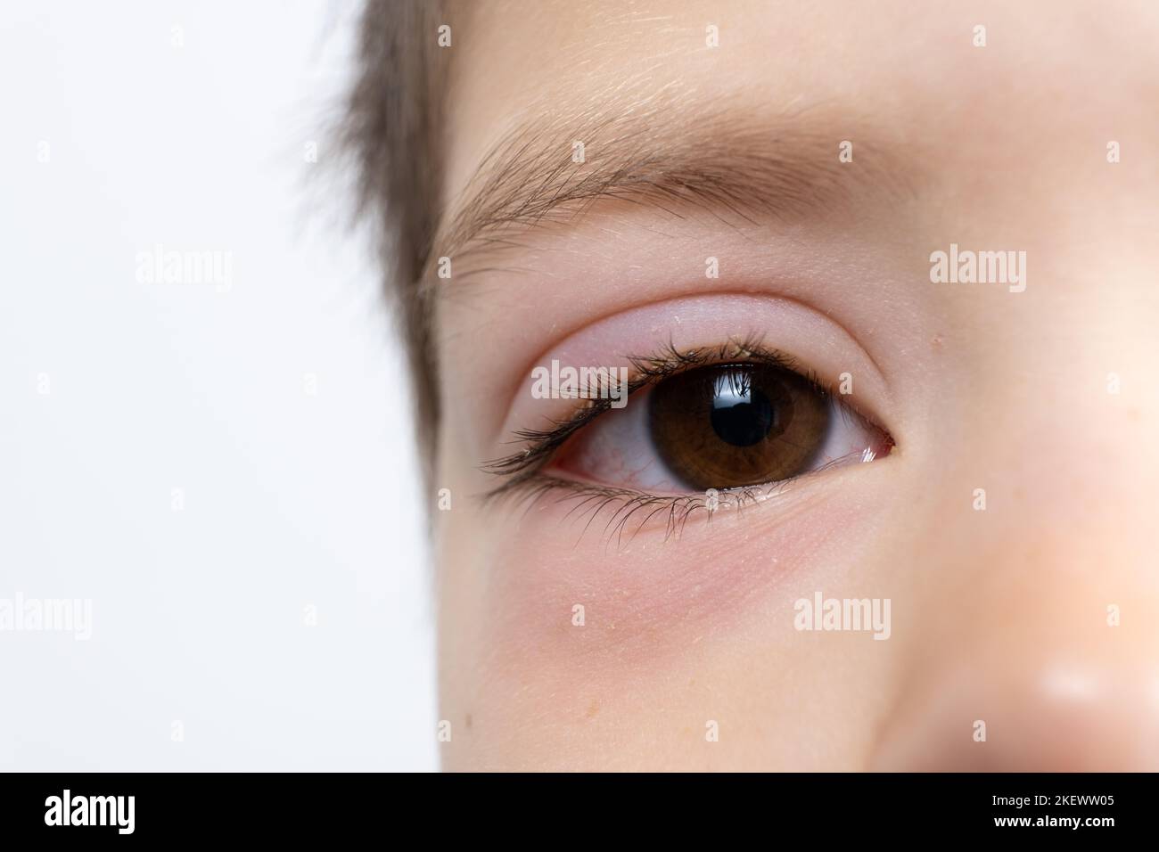 Occhio di un bambino con congiuntivite, infiammazione della congiuntiva, primo piano. Foto Stock