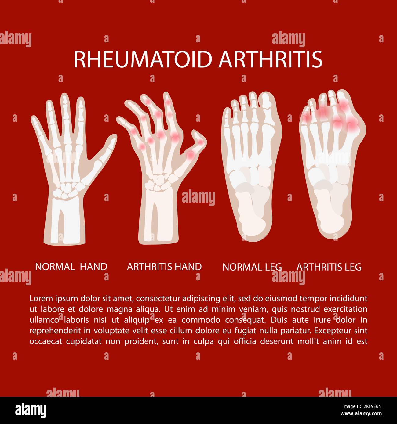 ARTRITE GAMBA MANO malattia cronica reumatoide Medicina diagramma di educazione Schema vettoriale mano umana disegnata vettore Illustrazione Illustrazione Vettoriale