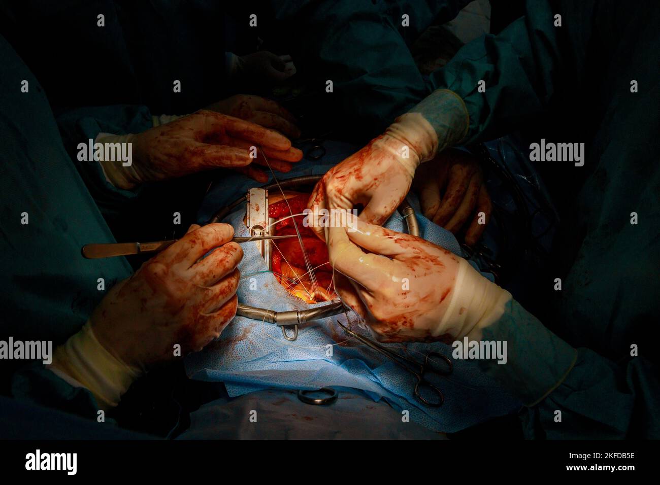 La sostituzione della valvola viene eseguita in sala operatoria quando una valvola malfunzionante il cuore provoca un intervento chirurgico a cuore aperto Foto Stock