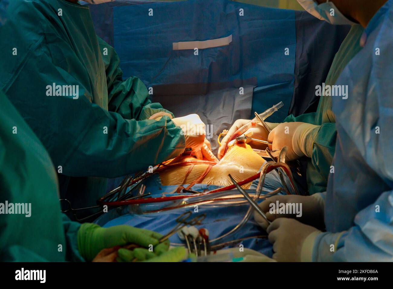 Intervento chirurgico a cuore aperto a causa di un malfunzionamento della valvola cardiaca, la sostituzione della valvola viene eseguita nella sala operatoria dell'ospedale Foto Stock