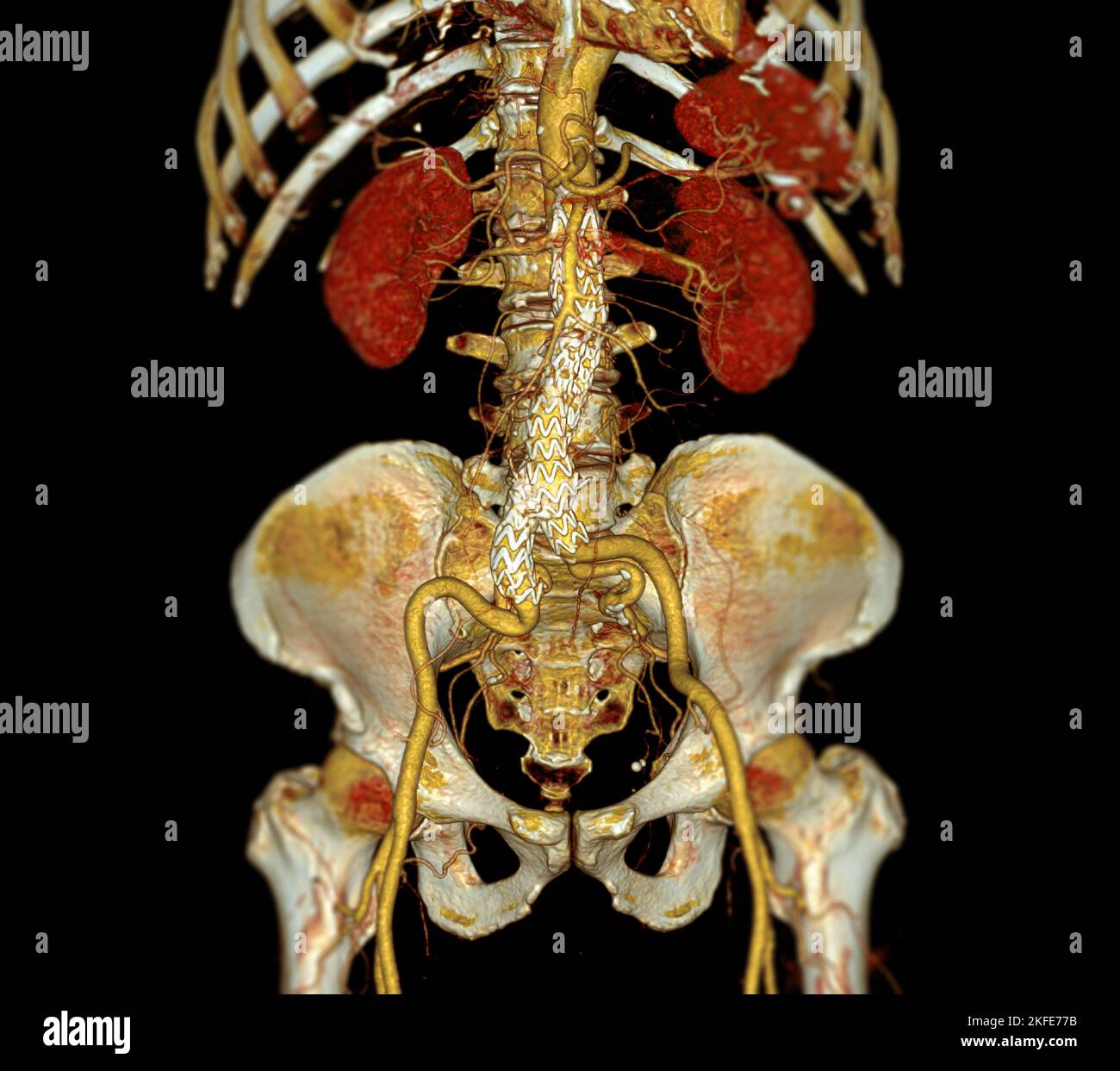 CTA aorta intera con innesto di stent aorta addominale confrontare l'immagine di rappresentazione 3D nel caso di aneurismi aortici addominali. Foto Stock