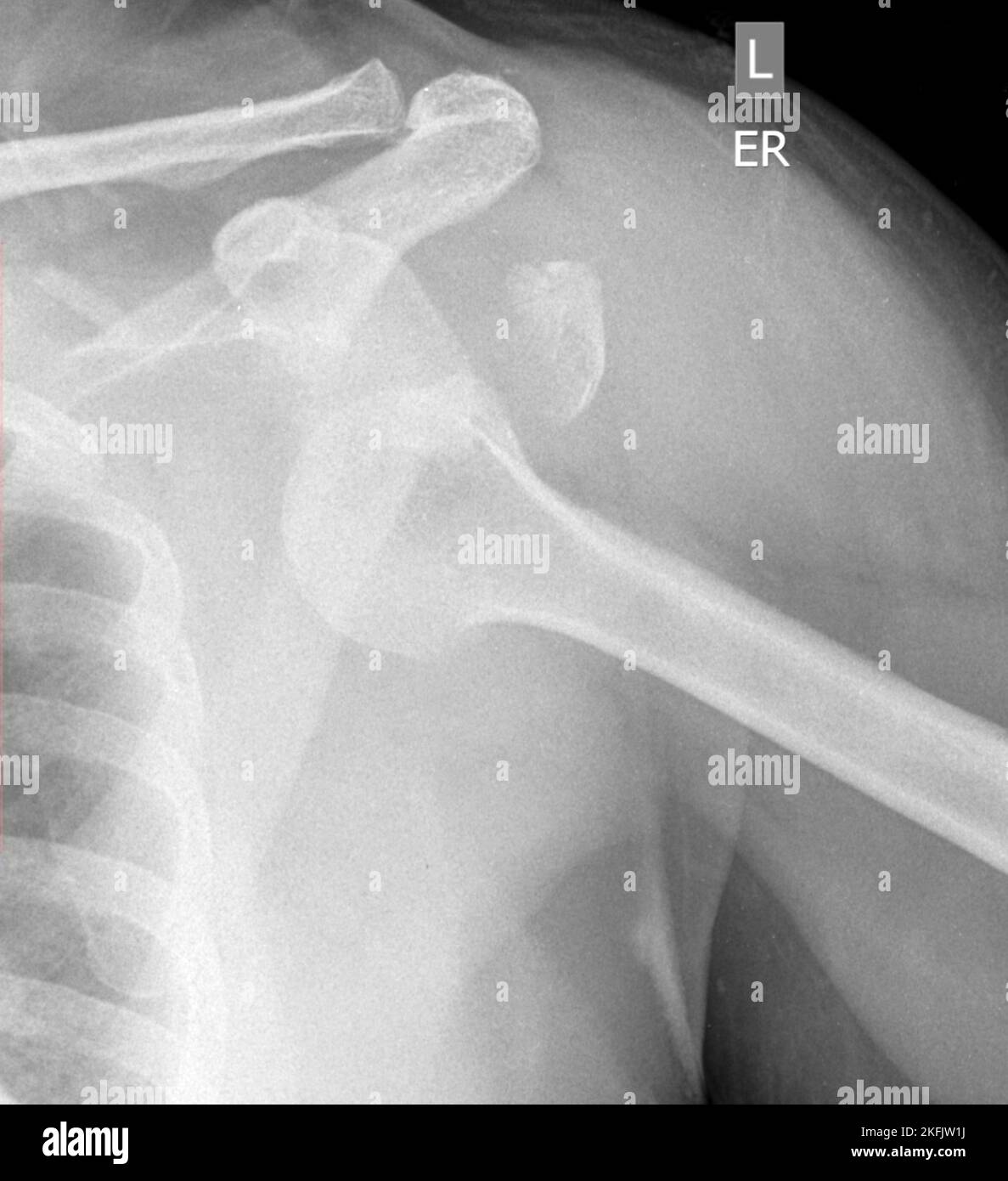 Spalla slogata, X-ray Foto Stock