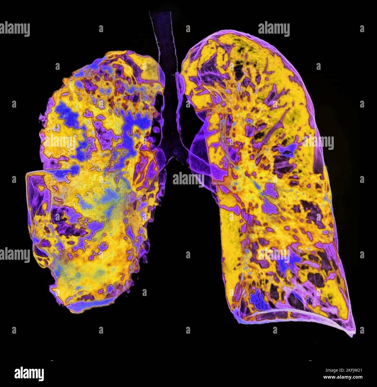 Polmonite, scansione TC 3D Foto Stock