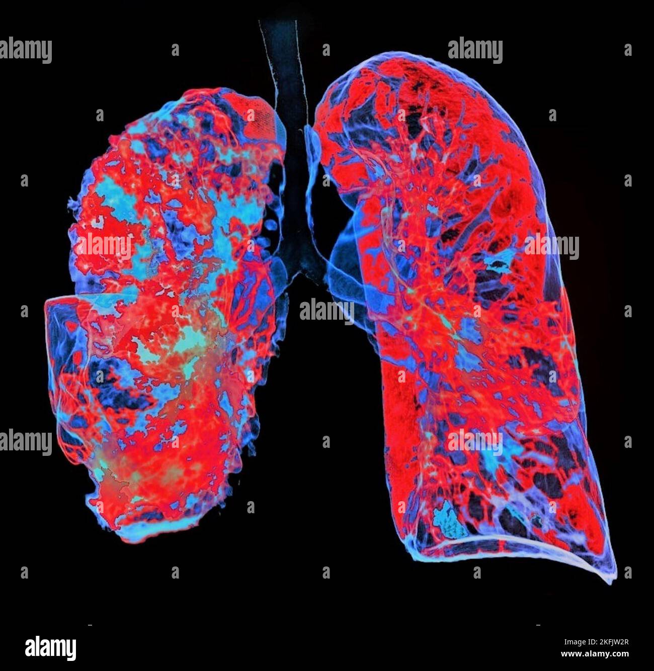 Polmonite, scansione TC 3D Foto Stock