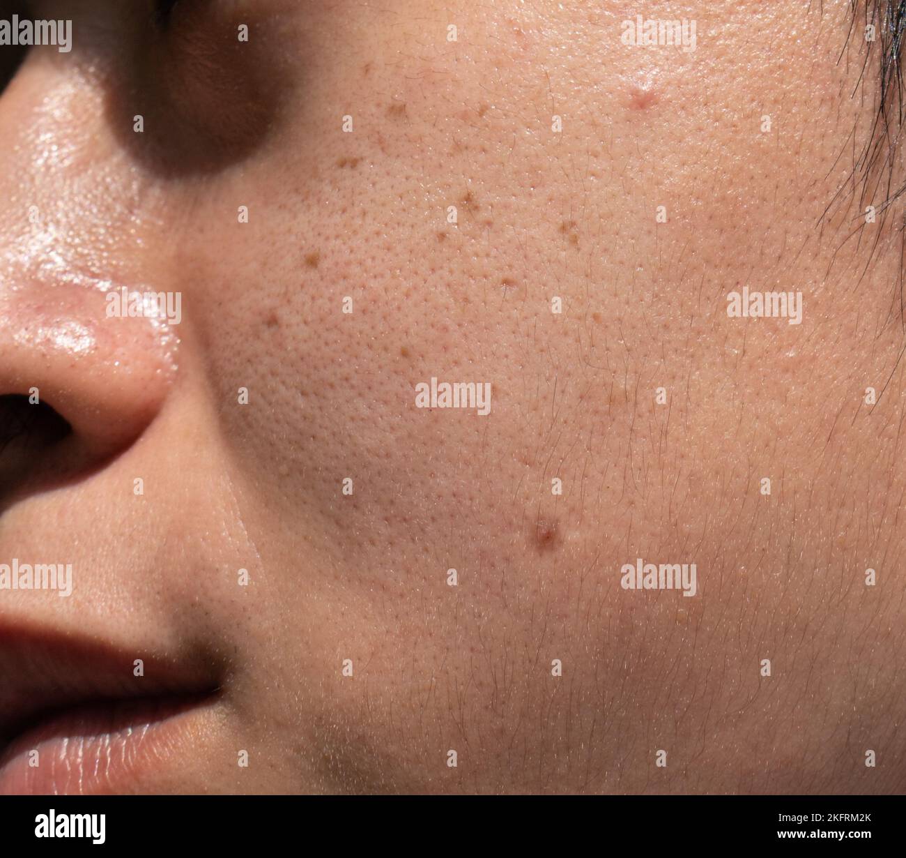 Macchie scure chiamate macchie di età e sul volto dell'uomo asiatico. Sono anche chiamati macchie di fegato, lentigo senile, o macchie di sole. Vista in primo piano. Foto Stock
